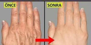 Ünlü Dermatoloji Uzmanın T-a’rifi İle Ciltteki Lekelerden K’urtulun.