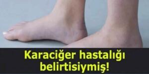 Karaciğerin Bittiğini Gösteren