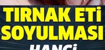Tırnak Eti Soyulması Ba’kın Neden Olur, Hangi Hastalığın Belirtisidir..